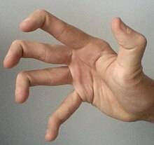 220px-Hypermobile_fingers_and_thumb.jpg