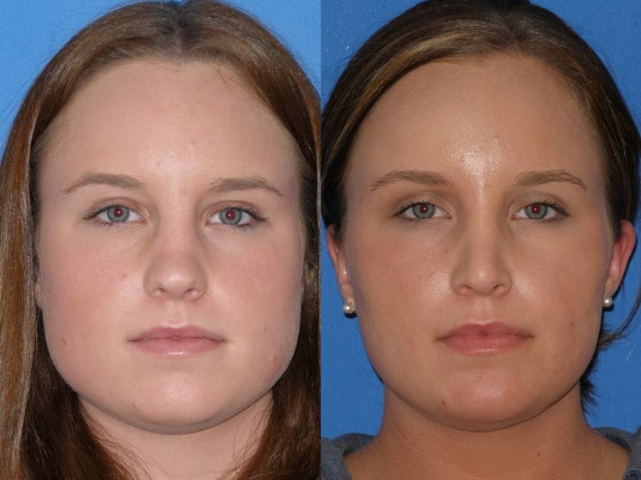 botox-jaw-reduction-woman4.jpg