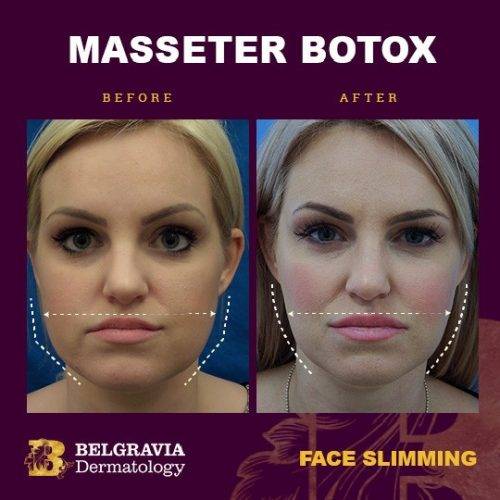 Botox-masseter-showing-jaw-reduction-500x500.jpg