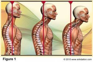 Forward-Head-Posture-Denver-Chiropractor_0-300x201.jpg