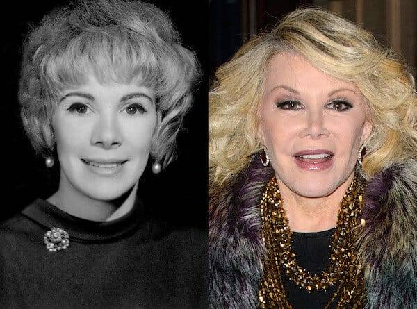 joan-rivers-before-after-plastic-surgery-2.jpg