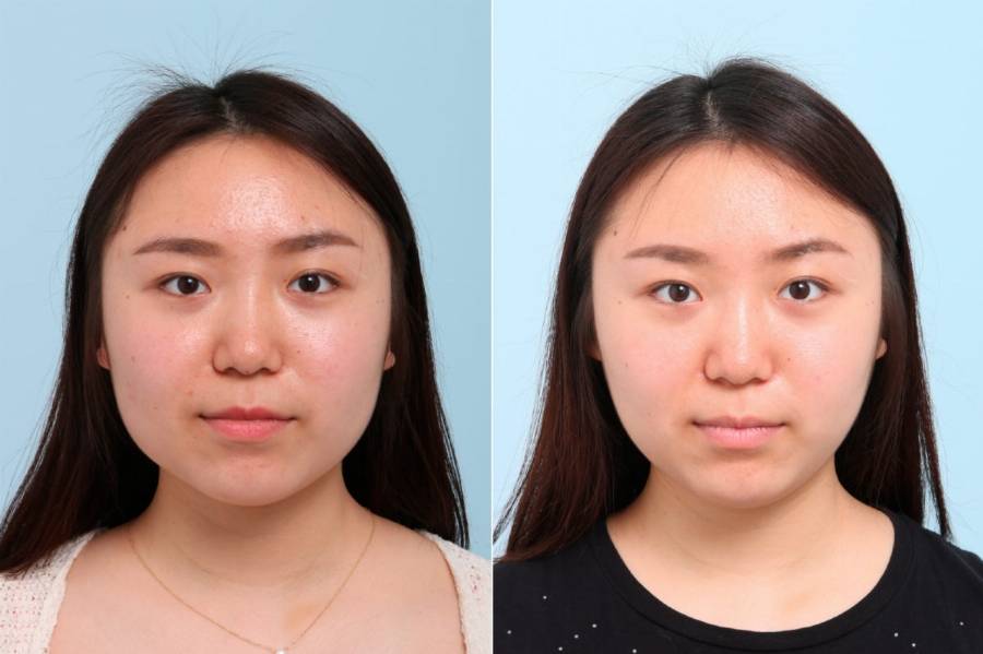 patient-7764-botox-cosmetic-before-after-1200x799.jpg